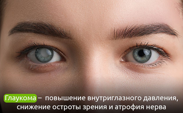 Глаукома: тяжелое глазное заболевание Повышение внутриглазного давления: признак глаукомы